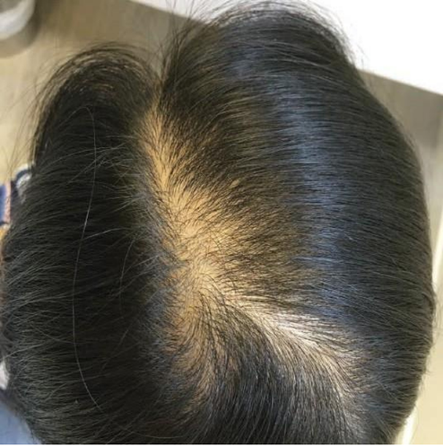 MALE PATTERN HAIR LOSS - Before