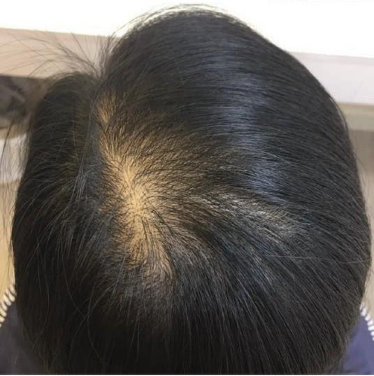 MALE PATTERN HAIR LOSS - After
