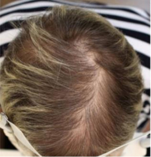 FEMALE PATTERN HAIR LOSS - Before