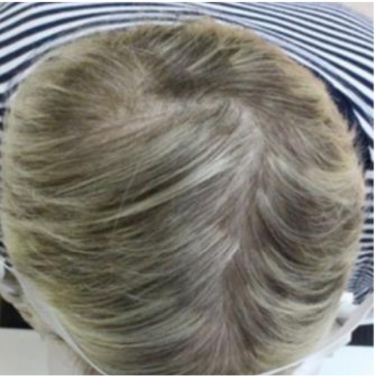FEMALE PATTERN HAIR LOSS - After